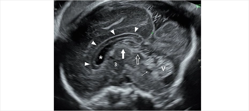 그림 1. Midsagittal plane of fetal head. Anatomical landmarkrs: corpus callosum (arrowhead), cavum septi pellicidi (asterisk), third ventricle (3), cerebellar vermis (V), fourth ventricle (dashed arrow), tela choroidea (arrow), quadrigeminal cistern (open arrow).