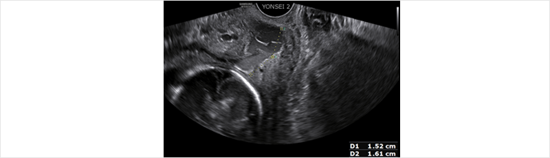 [figure 1] cervix canal 주변에 2*1cm sized hypoechoic lesion 관찰됨.