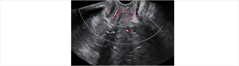 [figure 1] cervix canal 주변에 2*1cm sized hypoechoic lesion 관찰됨.