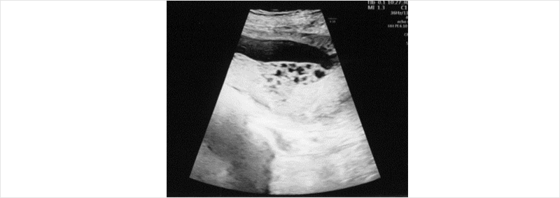 Figure 1. Ultrasonography at pregnancy 11+3 weeks, 2nd baby’s placenta shows multicystic appearance