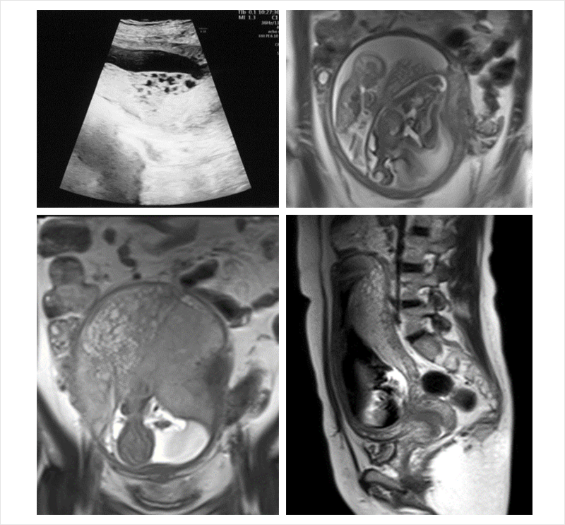 Figure 2. MRI at pregnancy 14+4 weeks. Well-defined multicystic appearance in the placenta of smaller fetus(about 10cm extent)