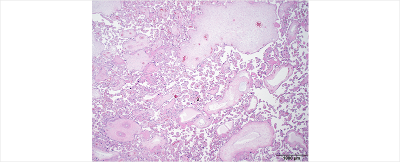 Figure 3. Histologic finding of Placental mesenchymal dysplasia. Edematous stem villi, thick-walled blood vessel are typical histologic finding of Placental mesenchymal dysplasia. 