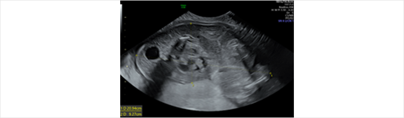 그림 1. 27주 발견한 21cm 크기의 무심장 쌍태아