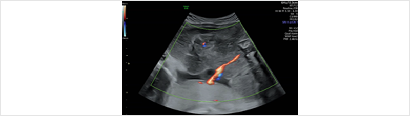그림 2. 무심장 쌍태아를 향하는 역전 동맥 관류 (임신 27주 사진)