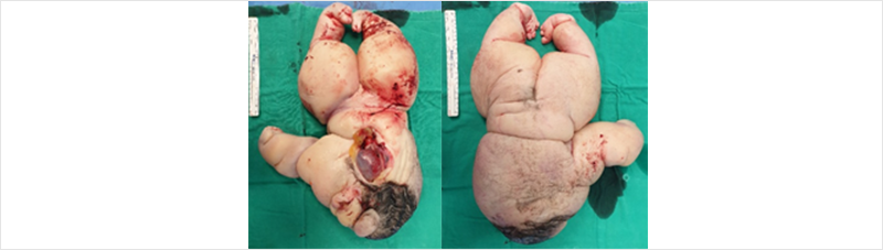 [figure 1] cervix canal 주변에 2*1cm sized hypoechoic lesion 관찰됨.